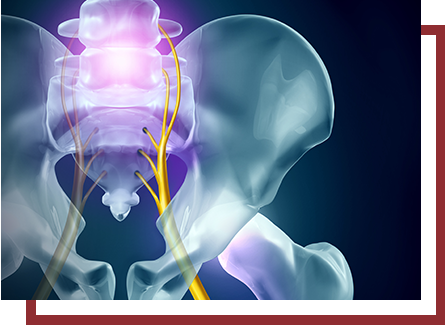 diagram of pinched nerve