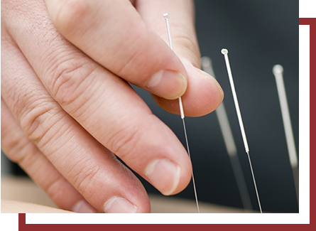 acupuncture needles